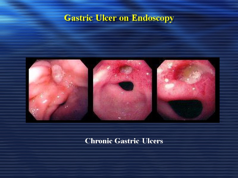 Gastric Ulcer on Endoscopy Chronic Gastric Ulcers